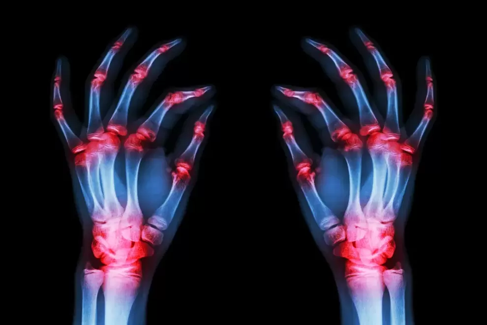 artrosis de las articulaciones de los dedos