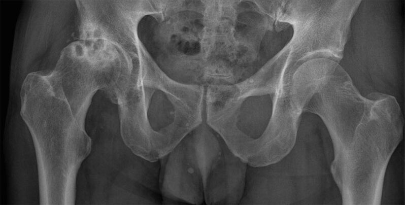 Artrosis en etapa 3 de la articulación de la cadera en una radiografía