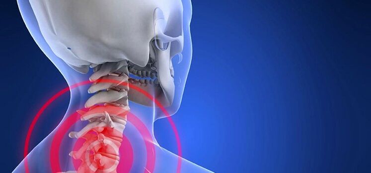 Osteocondrosis de la región cervical