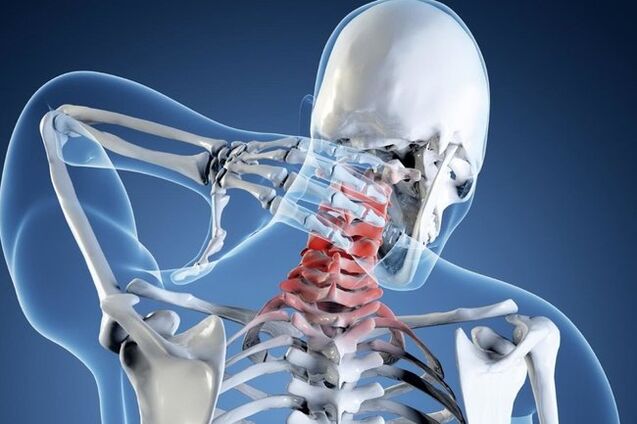 Osteocondrosis de la región cervical
