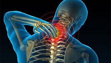 Síntomas de la osteocondrosis de la columna cervical