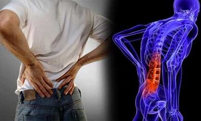 Las razones para el desarrollo de la osteocondrosis lumbar
