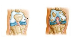 cambios patológicos en la artrosis de rodilla