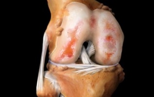 ¿Qué es la artrosis de la articulación de la rodilla 