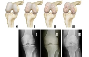 métodos para diagnosticar la artrosis de la rodilla
