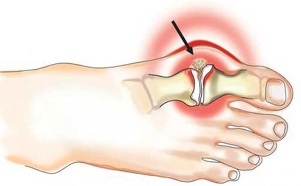 Inflamación de la articulación entre el pulgar y el pie en la artritis. 