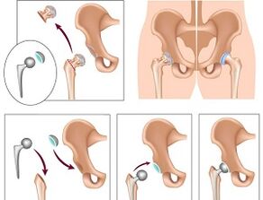 artroplastia para la artrosis de la articulación de la cadera