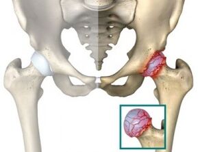 causas de atrosis de la articulación de la cadera