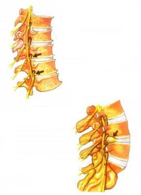 Ilustración de la osteocondrosis de la columna vertebral. 
