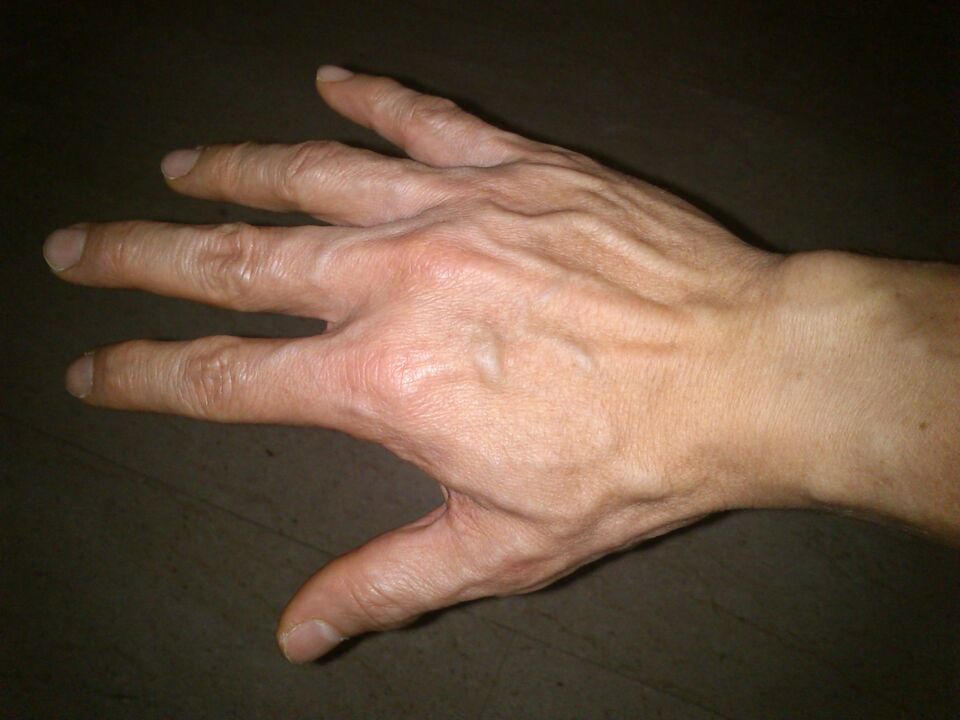 deformación de los huesos y dolor en las articulaciones de los dedos