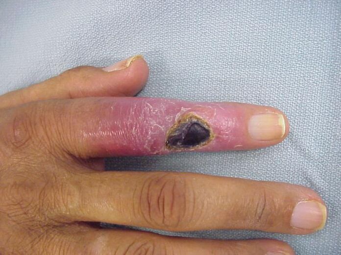 osteomielitis como causa de dolor en las articulaciones de los dedos
