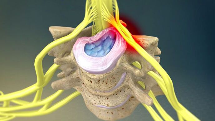 La protuberancia del disco intervertebral es la causa del dolor de cuello. 