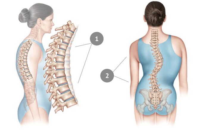 curvatura de la columna vertebral como causa de osteocondrosis torácica