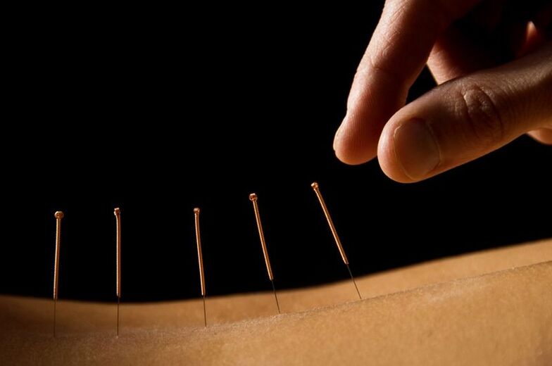 acupuntura para el dolor de espalda