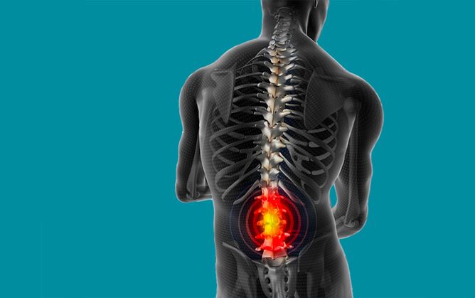 dolor de espalda en la región lumbar