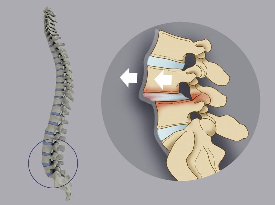desplazamiento de las vértebras como causa de dolor de espalda