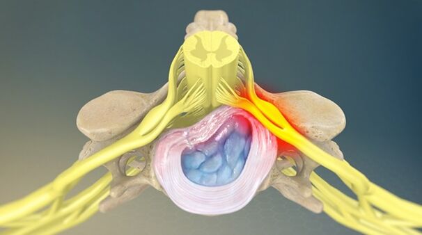 síndrome radicular como causa de dolor de espalda