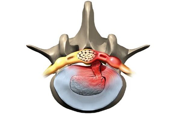 vértebra afectada por osteocondrosis