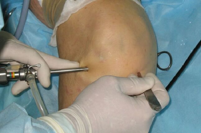 artroscopia para el dolor de rodilla